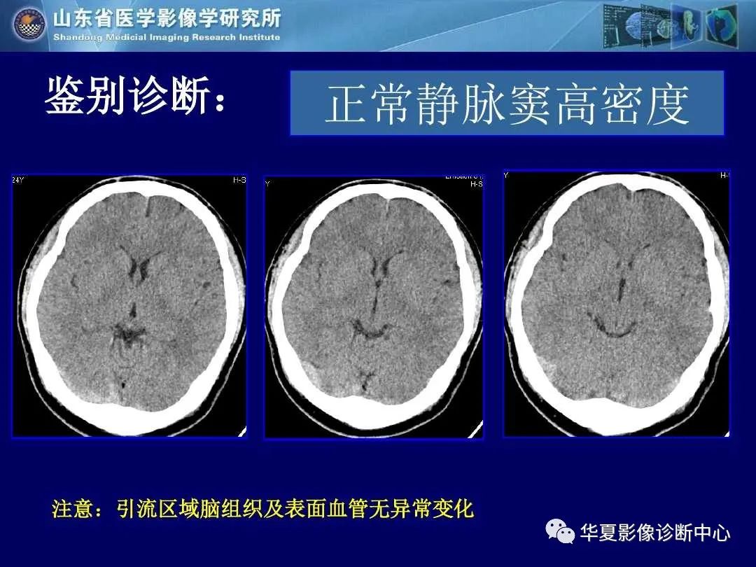 影像PPT - 【PPT】缺血性脑血管病的影像诊断-101