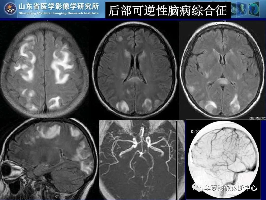 影像PPT - 【PPT】缺血性脑血管病的影像诊断-104
