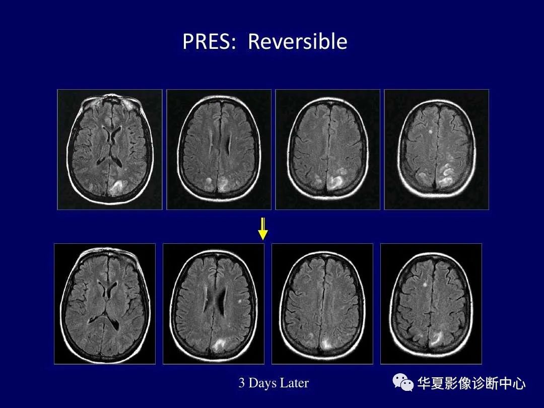 影像PPT - 【PPT】缺血性脑血管病的影像诊断-108