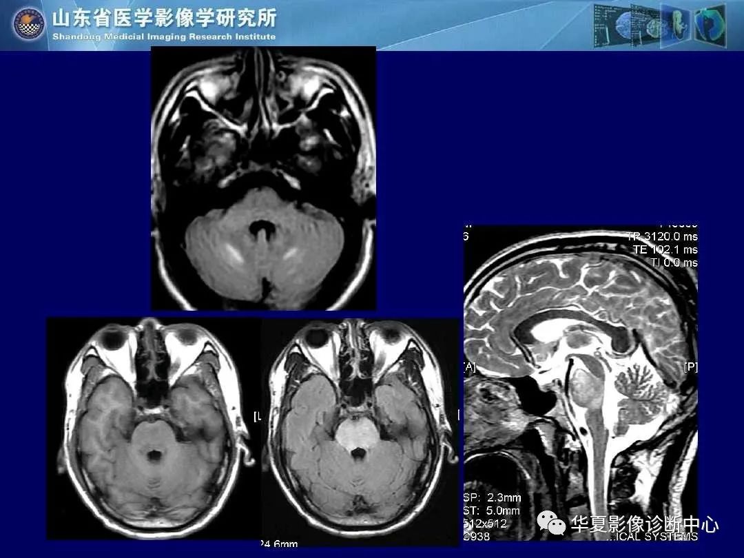 影像PPT - 【PPT】缺血性脑血管病的影像诊断-109