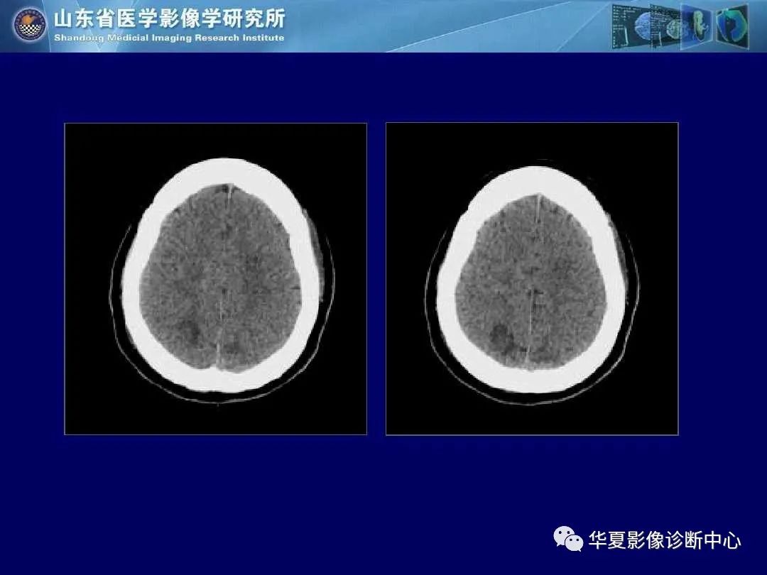 影像PPT - 【PPT】缺血性脑血管病的影像诊断-107