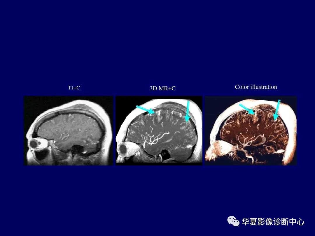 影像PPT - 【PPT】缺血性脑血管病的影像诊断-112