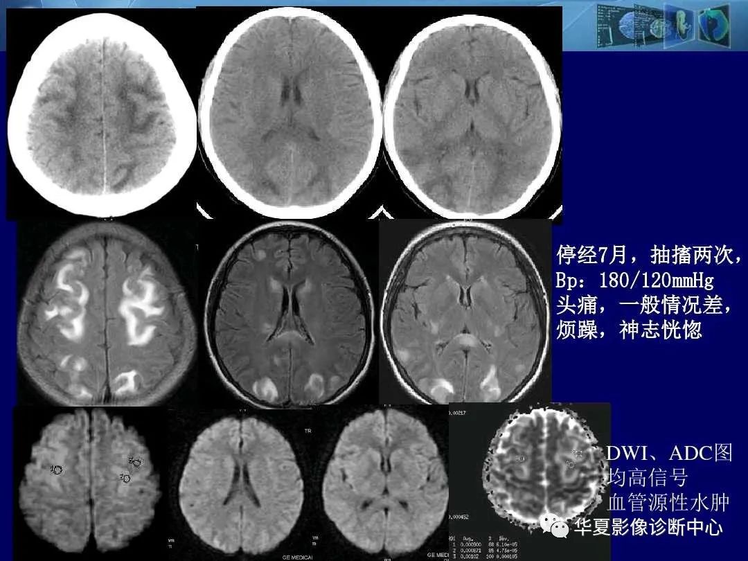 影像PPT - 【PPT】缺血性脑血管病的影像诊断-111