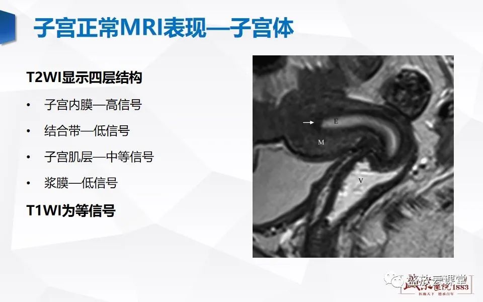 影像PPT - 【PPT】子宫病变MRI诊断-4