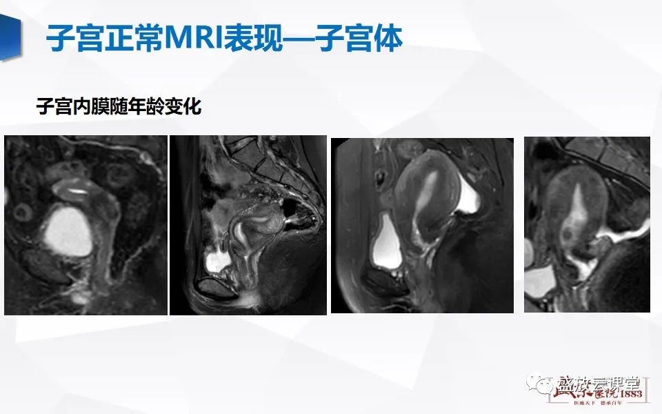 影像PPT - 【PPT】子宫病变MRI诊断-6