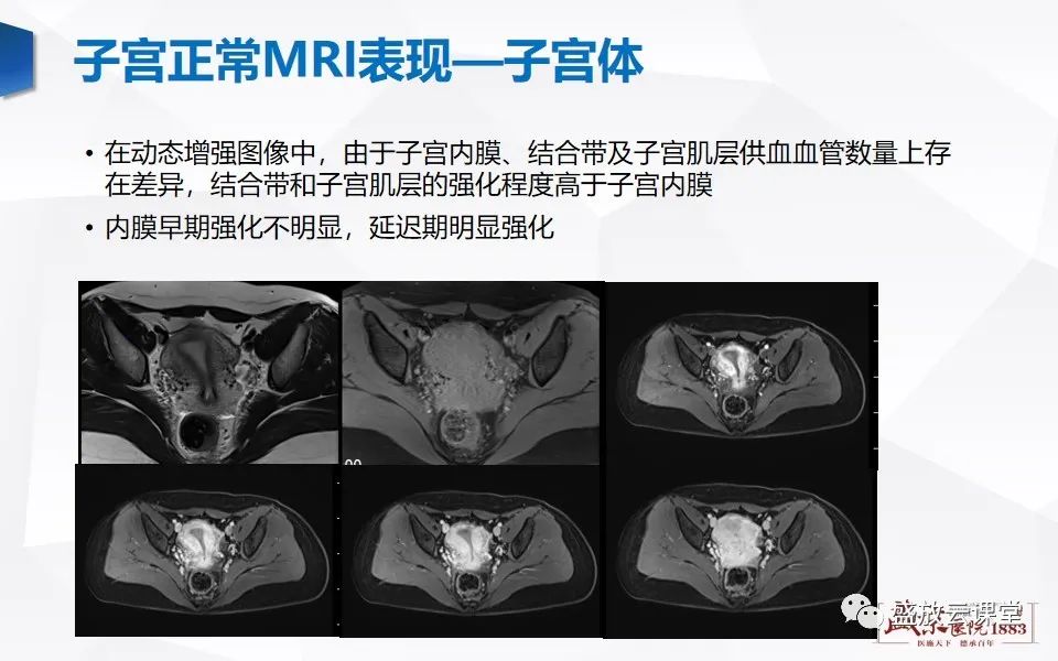 影像PPT - 【PPT】子宫病变MRI诊断-7
