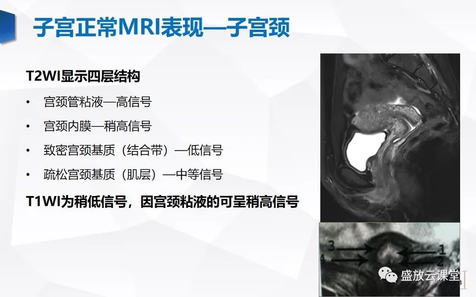 影像PPT - 【PPT】子宫病变MRI诊断-9