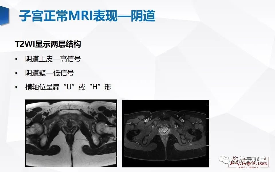 影像PPT - 【PPT】子宫病变MRI诊断-10