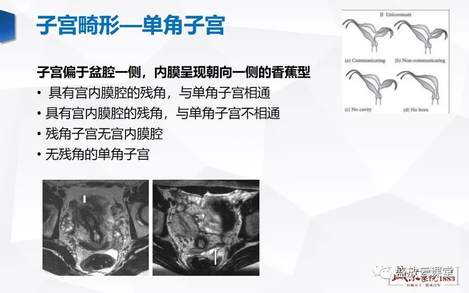 影像PPT - 【PPT】子宫病变MRI诊断-13