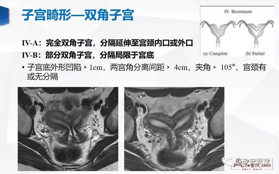 影像PPT - 【PPT】子宫病变MRI诊断-15