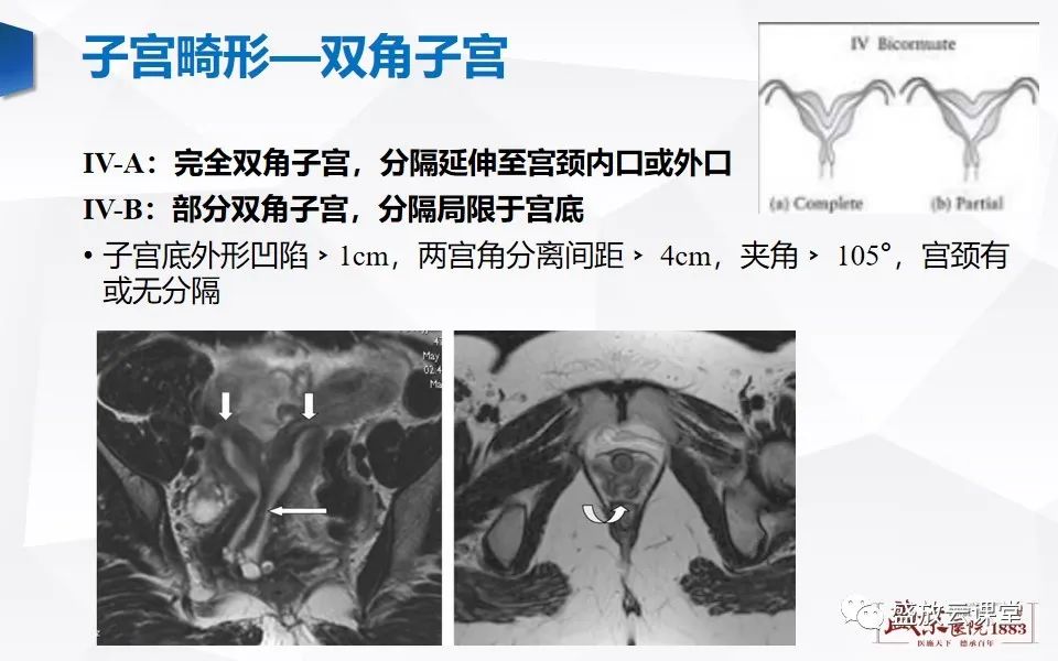影像PPT - 【PPT】子宫病变MRI诊断-16