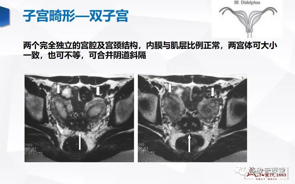 影像PPT - 【PPT】子宫病变MRI诊断-14