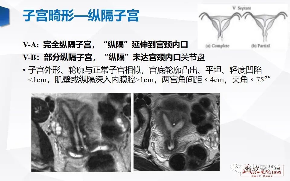 影像PPT - 【PPT】子宫病变MRI诊断-17
