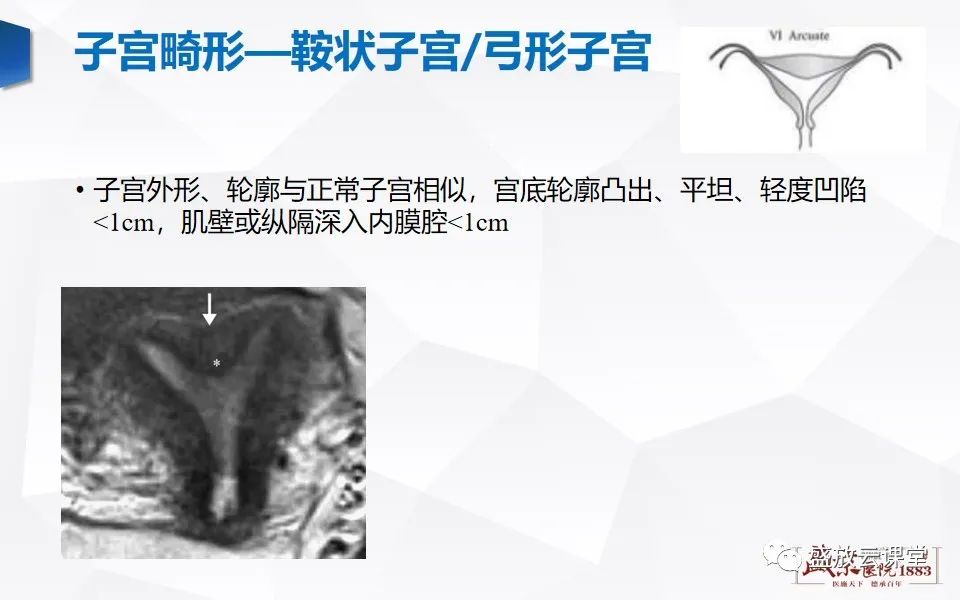 影像PPT - 【PPT】子宫病变MRI诊断-18