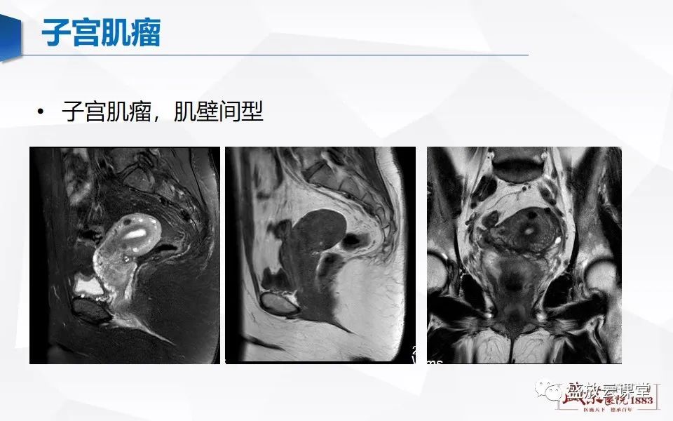 影像PPT - 【PPT】子宫病变MRI诊断-24
