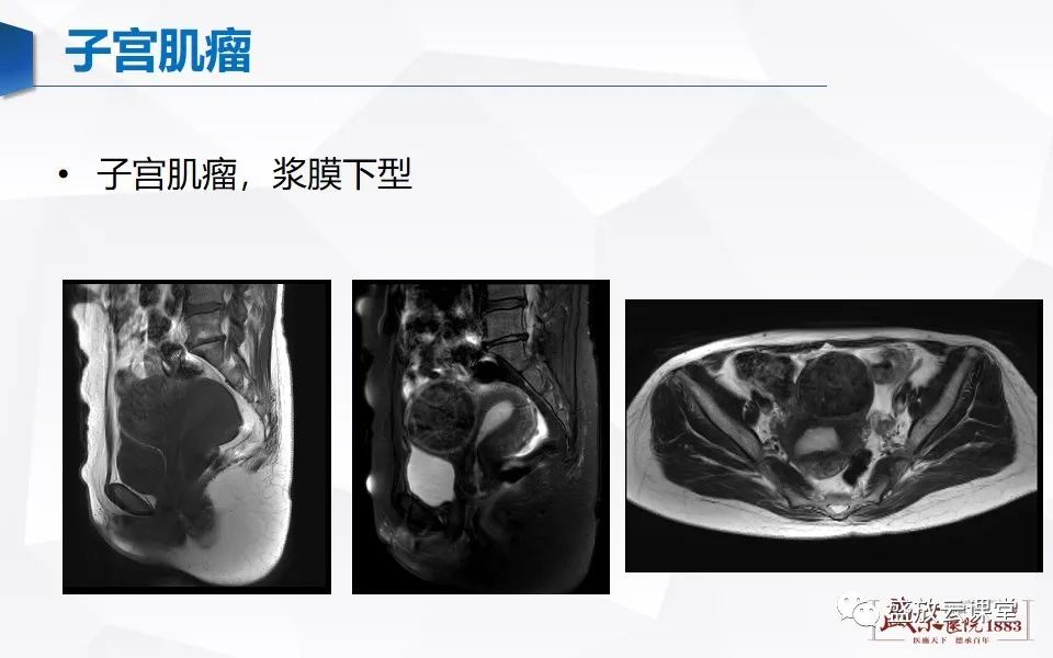 影像PPT - 【PPT】子宫病变MRI诊断-25