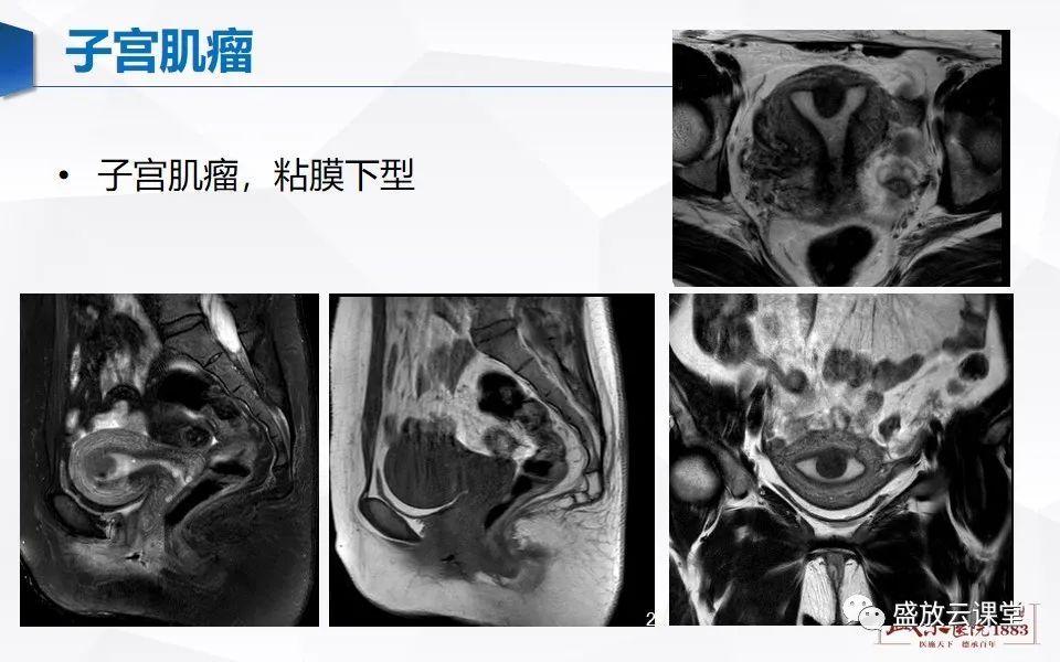 影像PPT - 【PPT】子宫病变MRI诊断-26