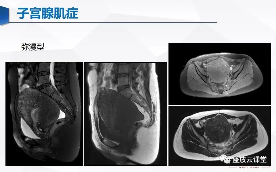 影像PPT - 【PPT】子宫病变MRI诊断-30
