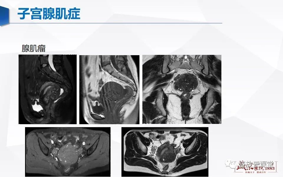 影像PPT - 【PPT】子宫病变MRI诊断-31