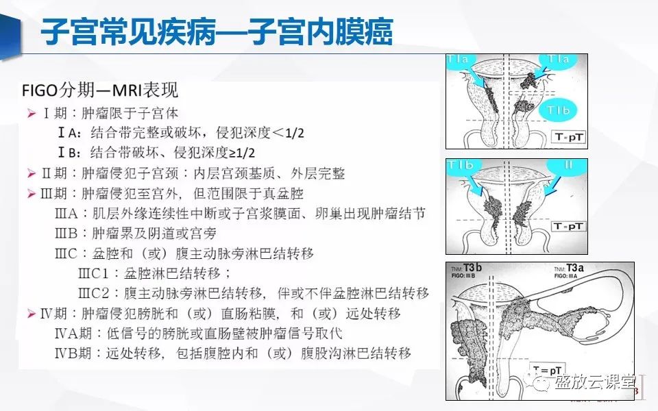 影像PPT - 【PPT】子宫病变MRI诊断-34