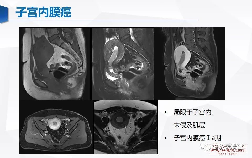 影像PPT - 【PPT】子宫病变MRI诊断-35