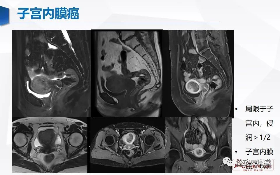 影像PPT - 【PPT】子宫病变MRI诊断-36