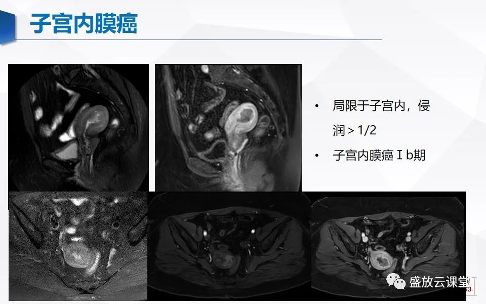 影像PPT - 【PPT】子宫病变MRI诊断-37