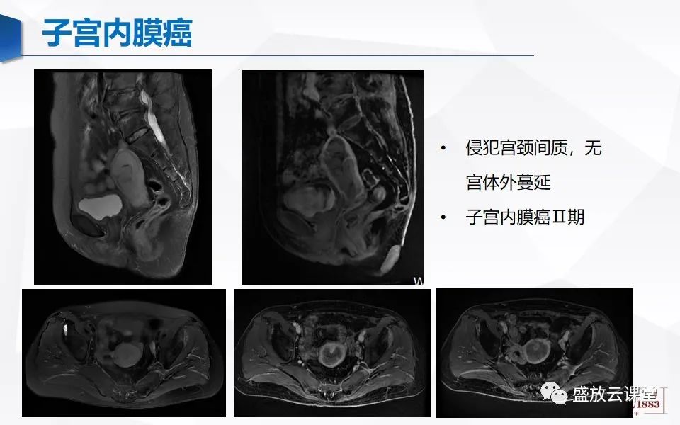 影像PPT - 【PPT】子宫病变MRI诊断-38