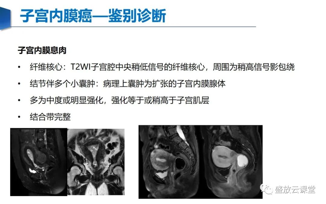 影像PPT - 【PPT】子宫病变MRI诊断-40