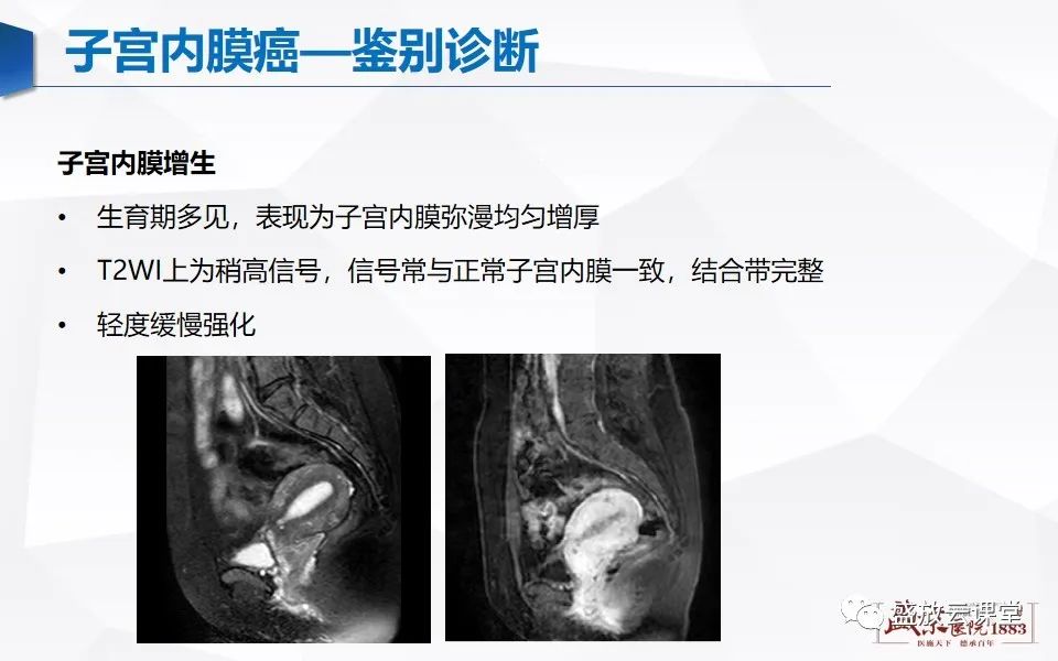 影像PPT - 【PPT】子宫病变MRI诊断-39