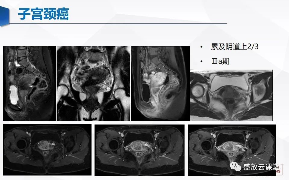 影像PPT - 【PPT】子宫病变MRI诊断-44