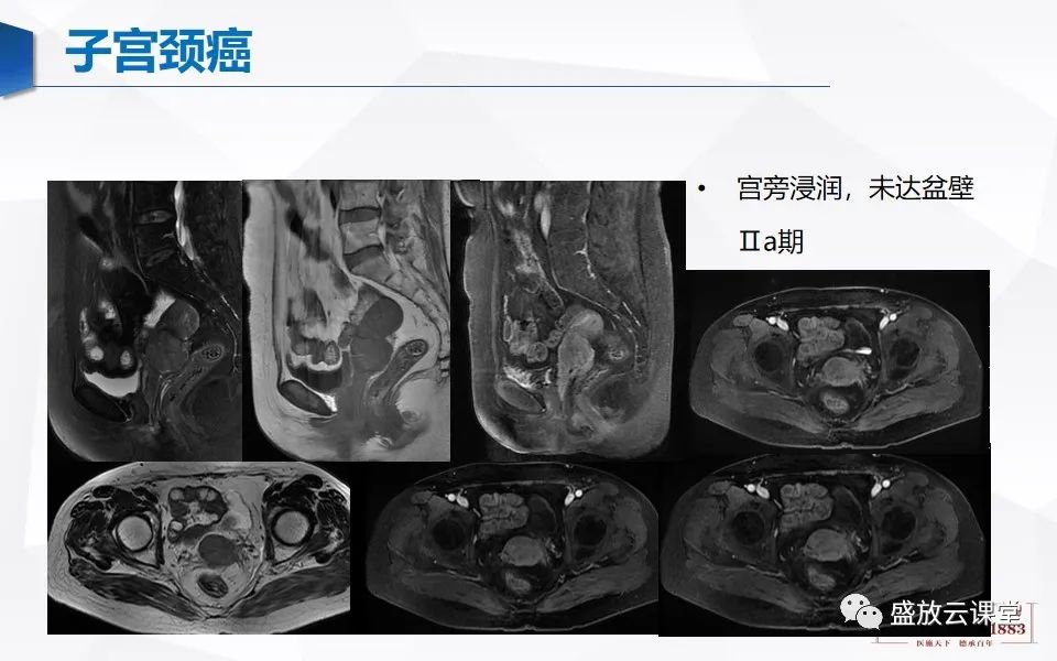 影像PPT - 【PPT】子宫病变MRI诊断-45