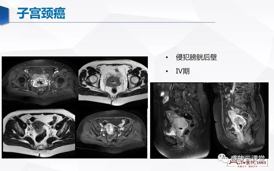 影像PPT - 【PPT】子宫病变MRI诊断-46