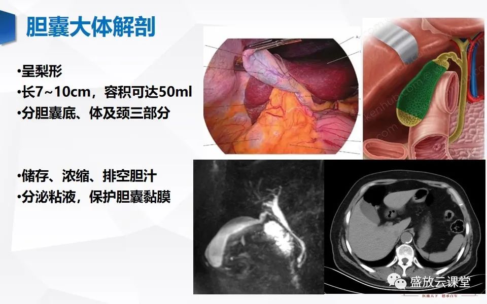 影像PPT - 【PPT】胆囊窝积液的影像学表现及临床意义-3