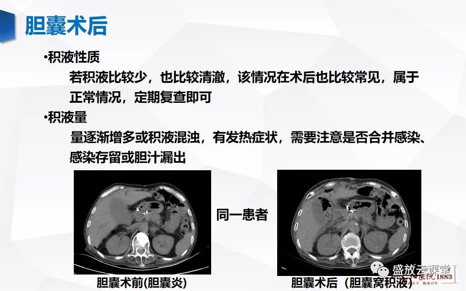 影像PPT - 【PPT】胆囊窝积液的影像学表现及临床意义-6