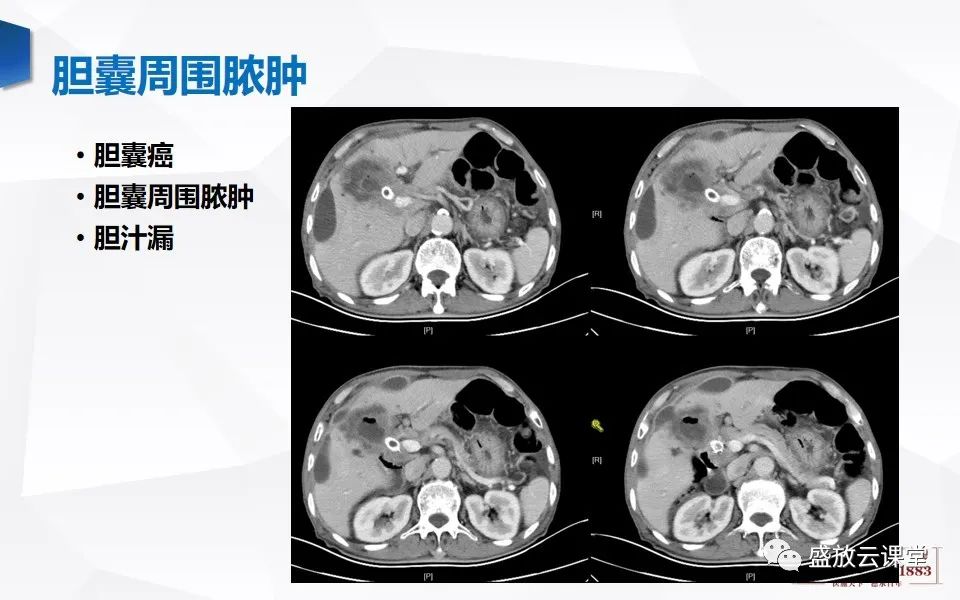 影像PPT - 【PPT】胆囊窝积液的影像学表现及临床意义-7