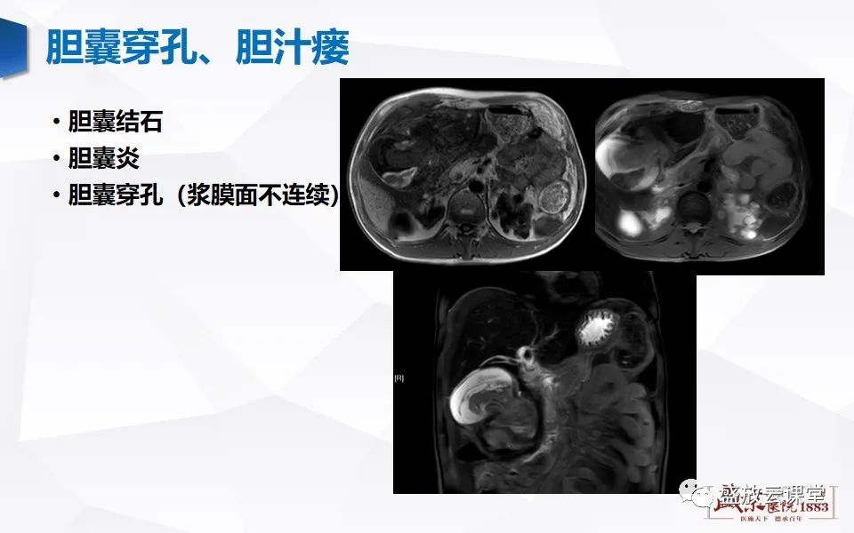 影像PPT - 【PPT】胆囊窝积液的影像学表现及临床意义-8