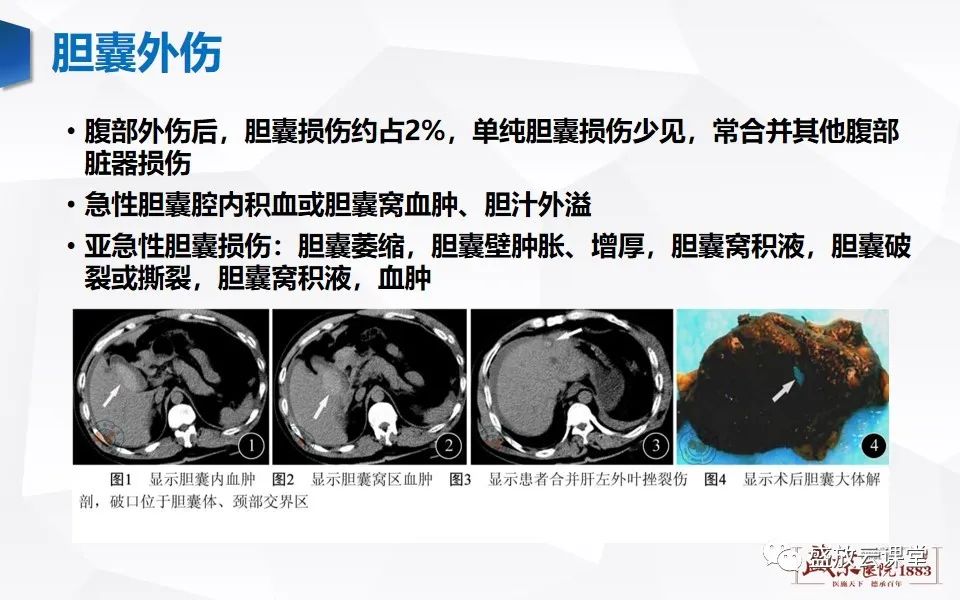 影像PPT - 【PPT】胆囊窝积液的影像学表现及临床意义-9
