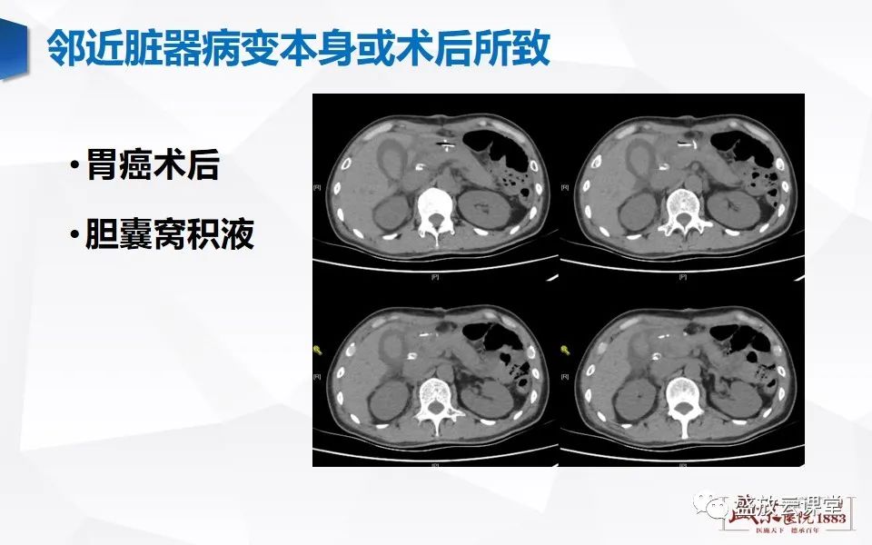 影像PPT - 【PPT】胆囊窝积液的影像学表现及临床意义-11