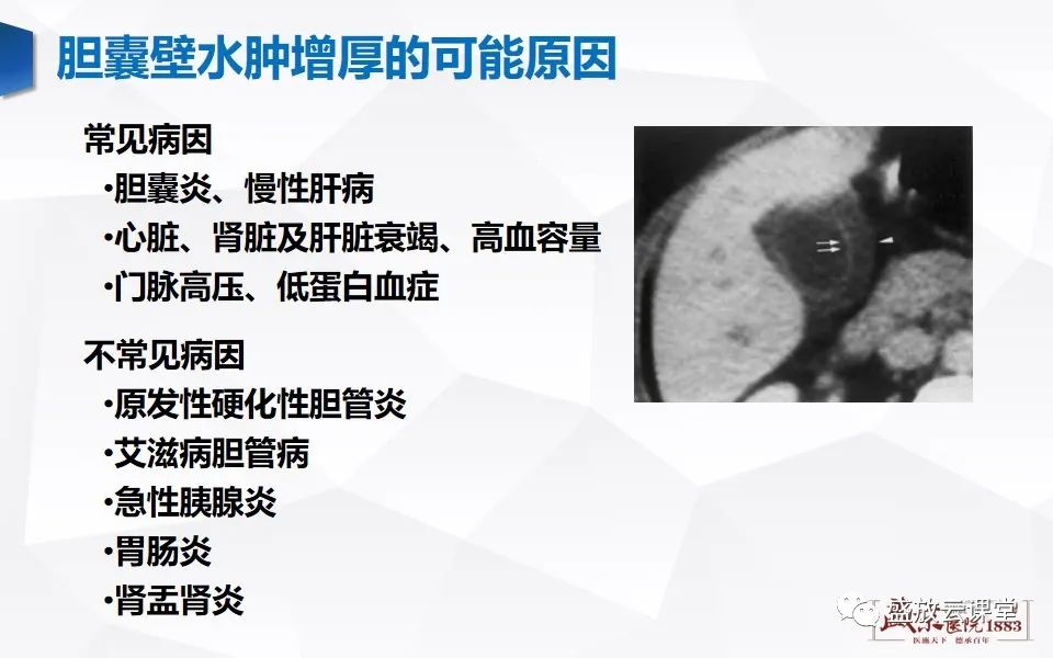 影像PPT - 【PPT】胆囊窝积液的影像学表现及临床意义-12