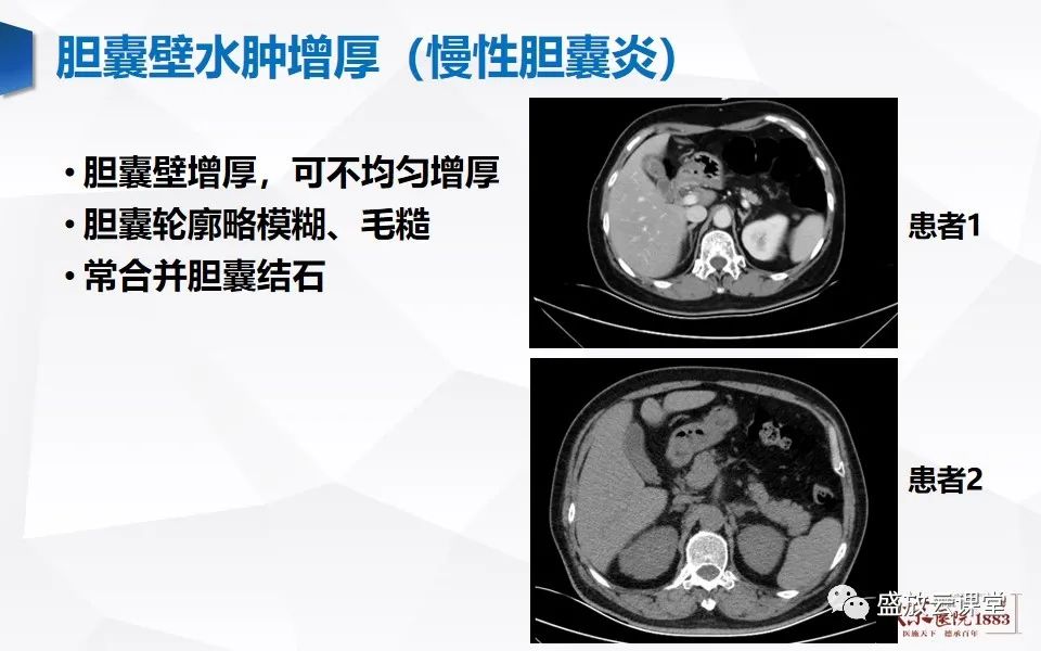 影像PPT - 【PPT】胆囊窝积液的影像学表现及临床意义-15