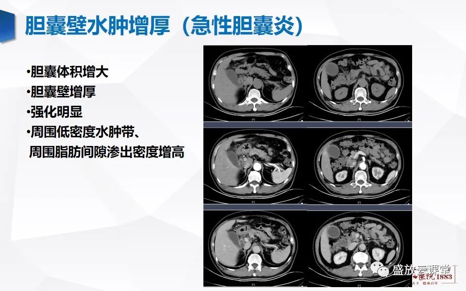 影像PPT - 【PPT】胆囊窝积液的影像学表现及临床意义-14
