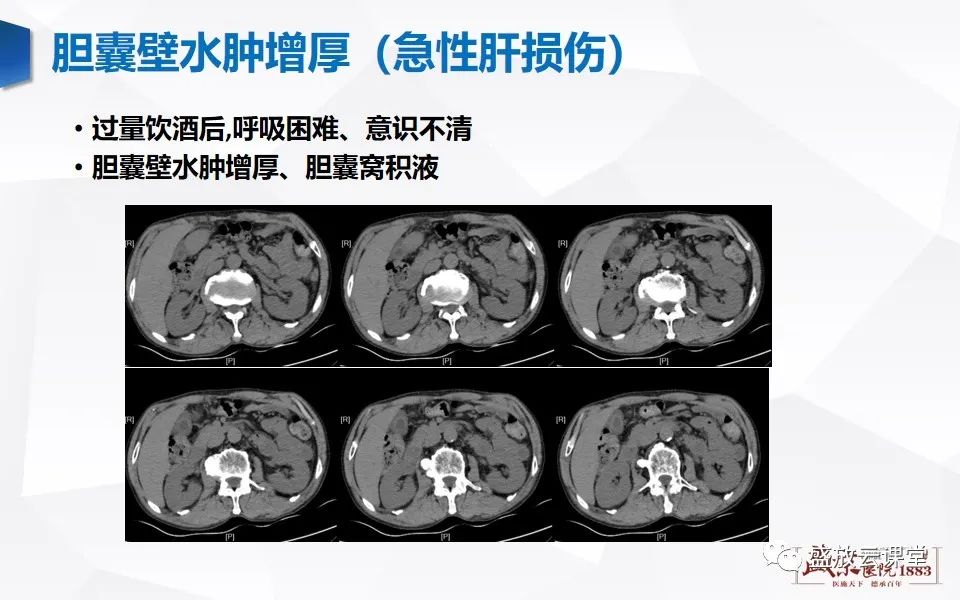 影像PPT - 【PPT】胆囊窝积液的影像学表现及临床意义-17