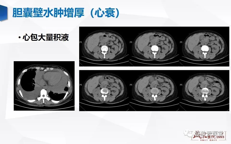 影像PPT - 【PPT】胆囊窝积液的影像学表现及临床意义-19