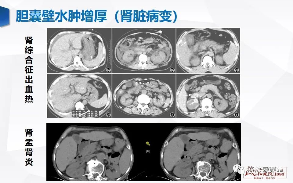 影像PPT - 【PPT】胆囊窝积液的影像学表现及临床意义-18