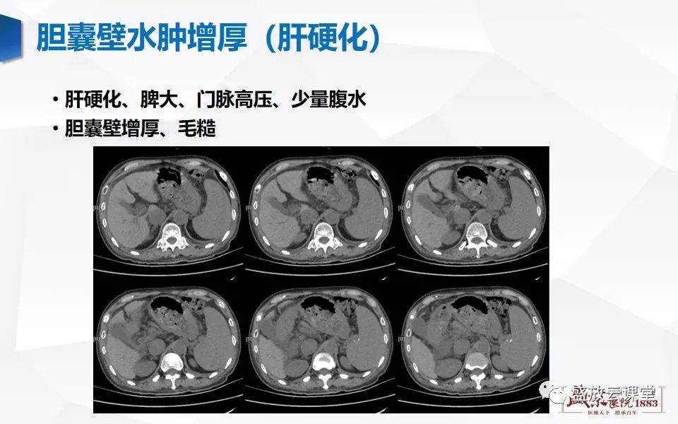 影像PPT - 【PPT】胆囊窝积液的影像学表现及临床意义-16