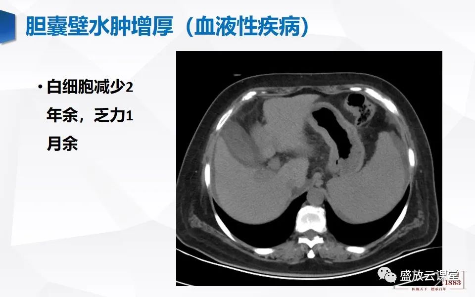 影像PPT - 【PPT】胆囊窝积液的影像学表现及临床意义-20