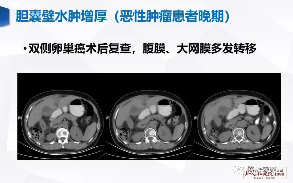 影像PPT - 【PPT】胆囊窝积液的影像学表现及临床意义-21