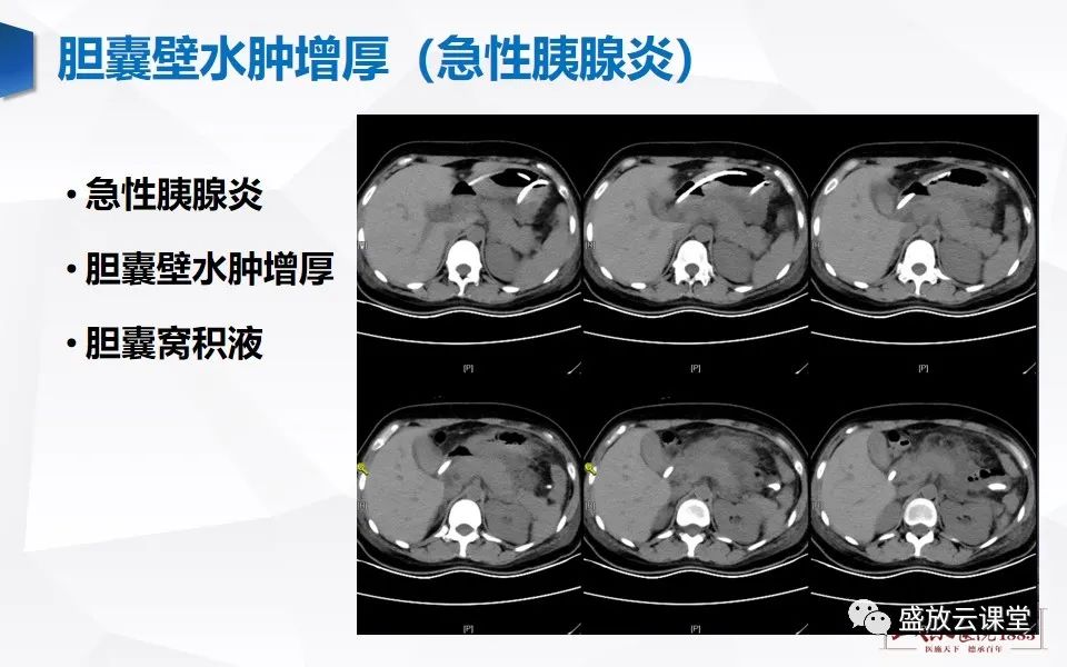 影像PPT - 【PPT】胆囊窝积液的影像学表现及临床意义-22