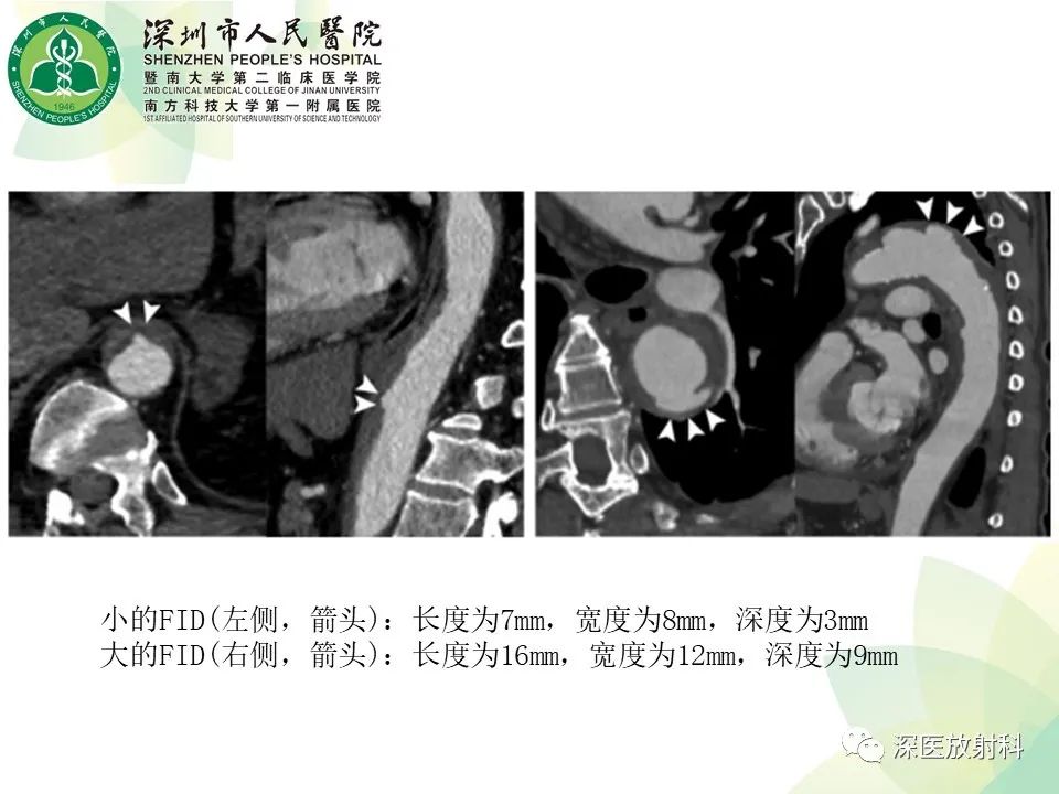 影像PPT - 【PPT】B型主动脉壁内血肿多层螺旋CT局灶性内膜破裂大小与疾病进展的关系-13